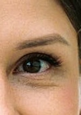 Black eyes